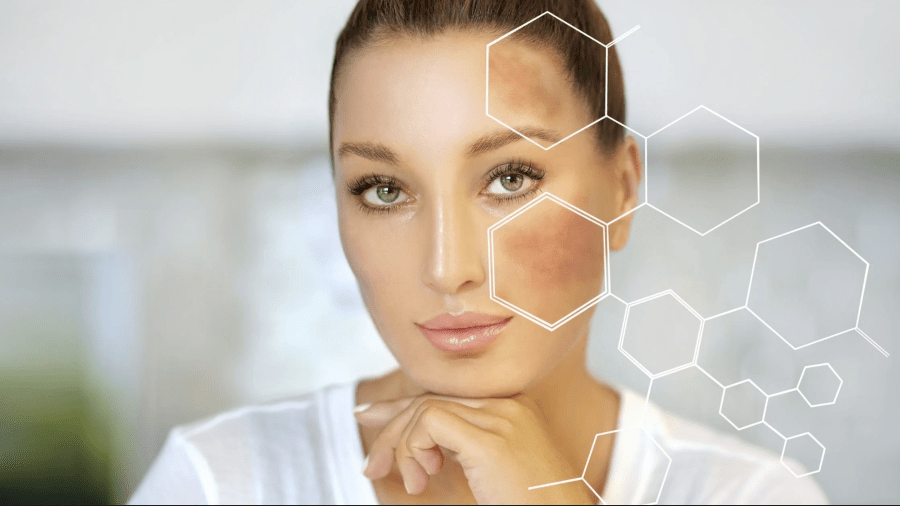 Advanced Treatments for Hyperpigmentation and Sun Damage Recent Studies Demonstrating the Benefits of These Treatments wpub.org